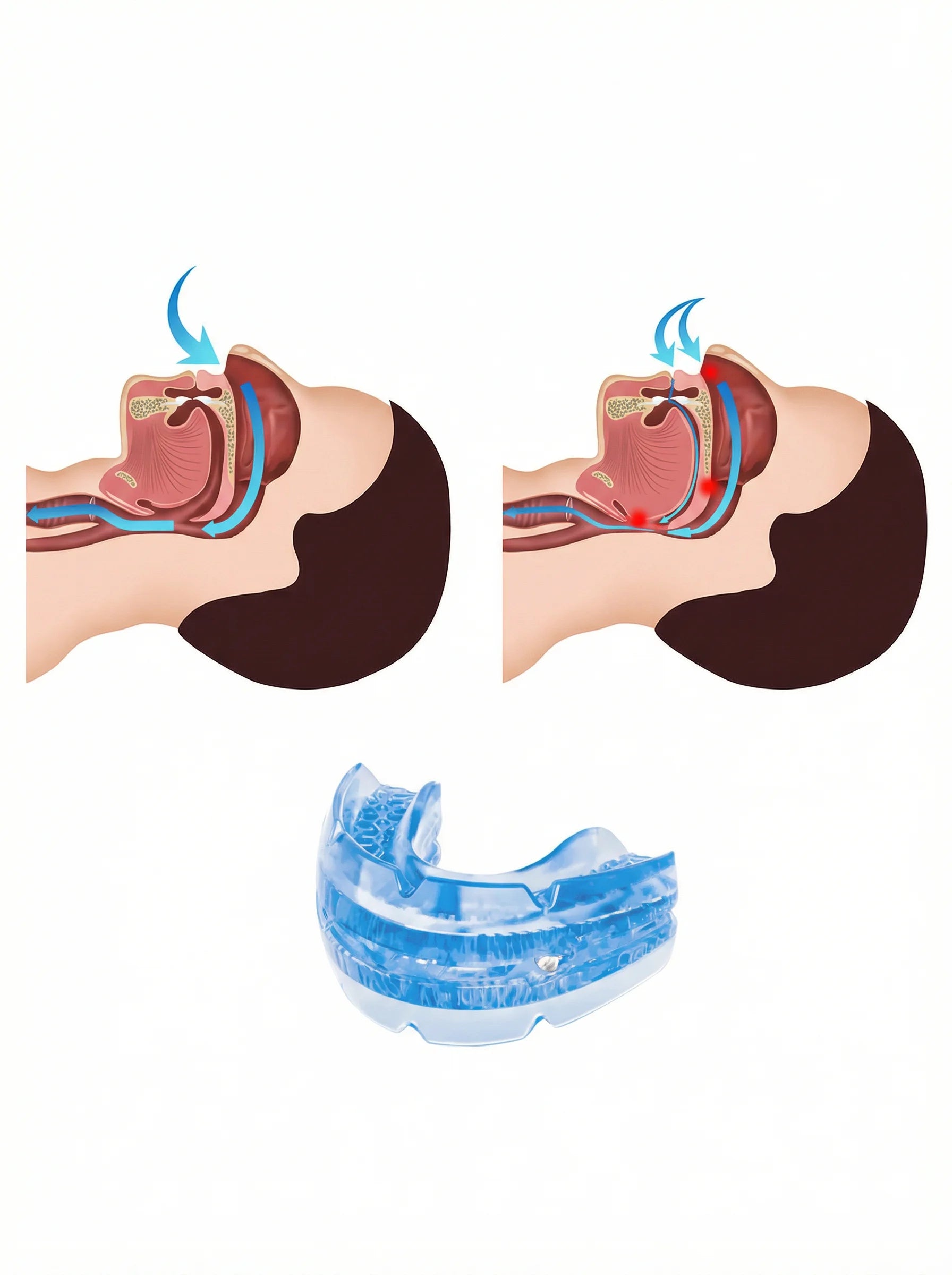 Ustnik Przeciw Chrapaniu | Aparat Na Chrapanie-Anti-Snoring Device-Polizatto