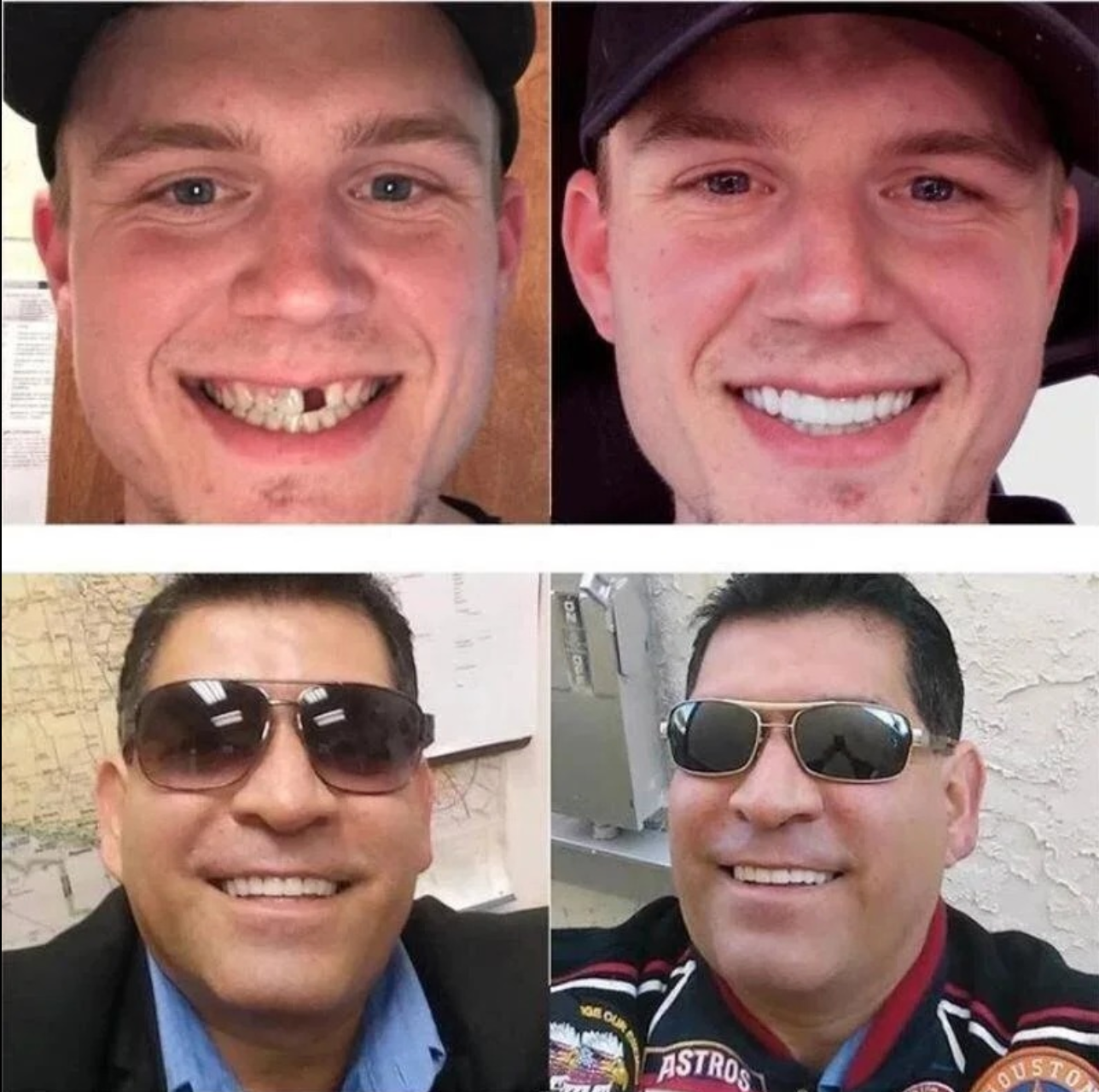 Licówki Tymczasowe | Snap-on Smile-Dentur-Polizatto